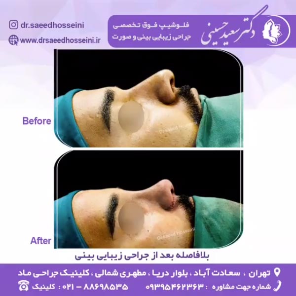 جراحی بینی ترمیمی