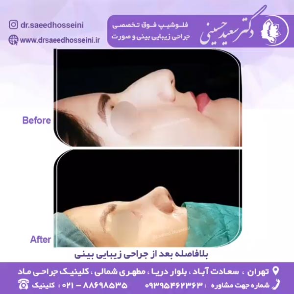 جراحی بینی ترمیمی