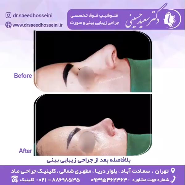 جراحی بینی ترمیمی