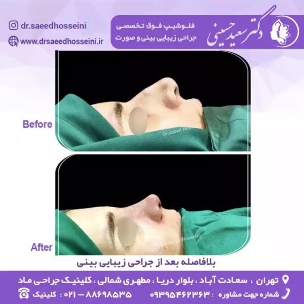 جراحی بینی کج