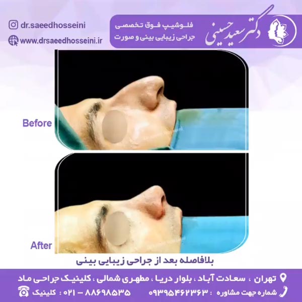 جراحی بینی کج