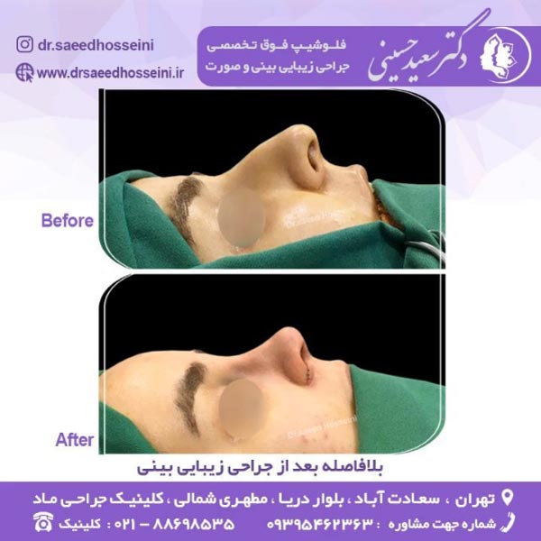 جراحی زیبایی بینی - دکتر سعید حسینی