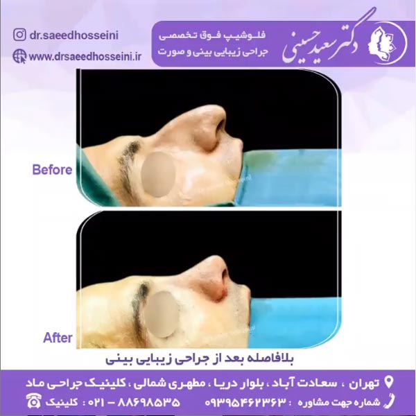 جراحی زیبایی بینی - دکتر سعید حسینی