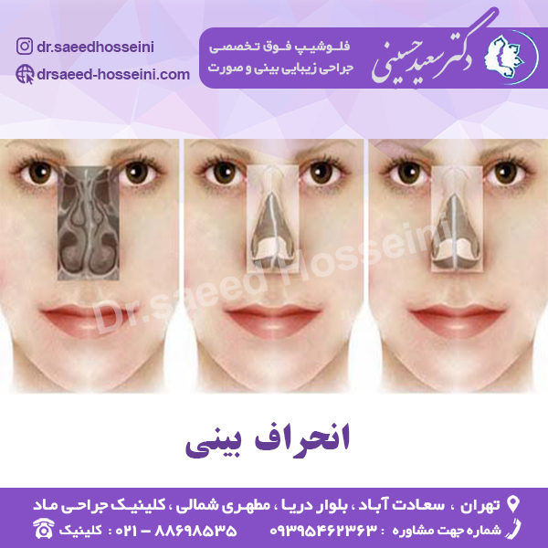 انحراف بینی