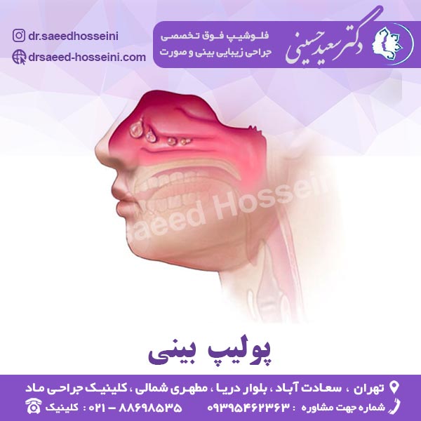 پولیپ بینی