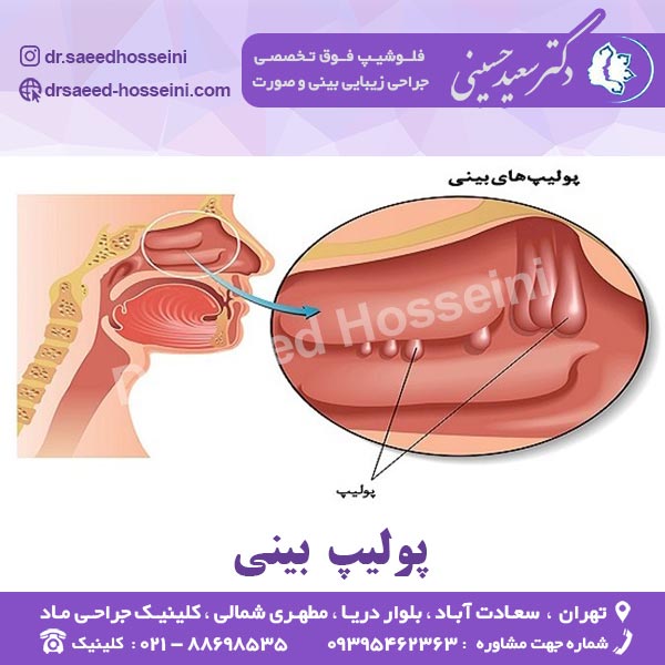 پولیپ بینی