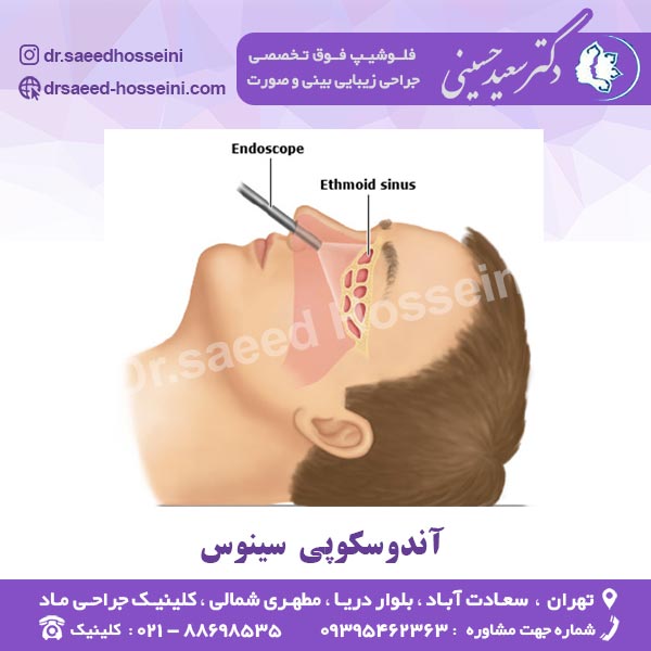 آندوسکوپی سینوس
