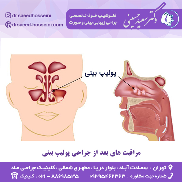 مراقبت های بعد از جراحی پولیپ بینی