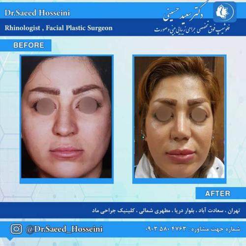 جراحی-بینی-253 (1)