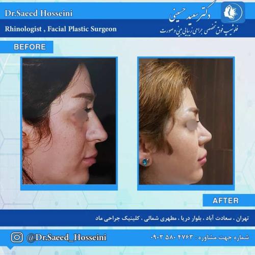 جراحی-بینی-254 (1)