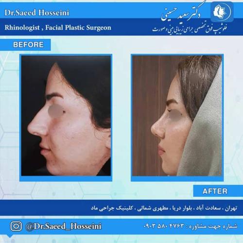 جراحی-بینی-256