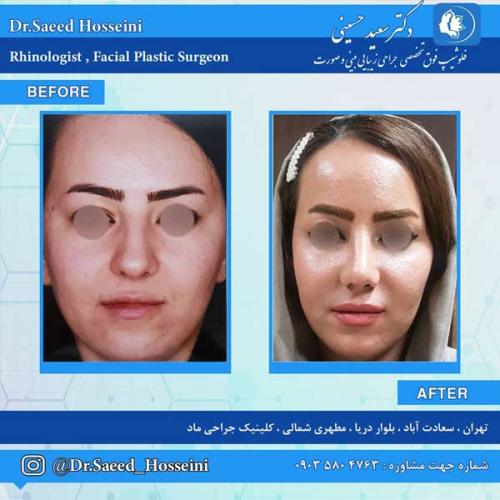 جراحی-بینی-258