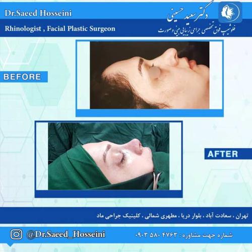 جراحی-بینی-259