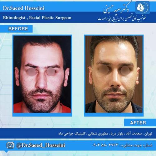 جراحی-بینی-260