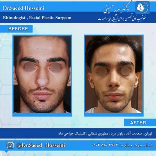 جراحی-بینی-261