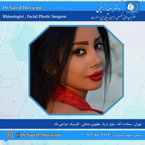 جراحی-بینی-263