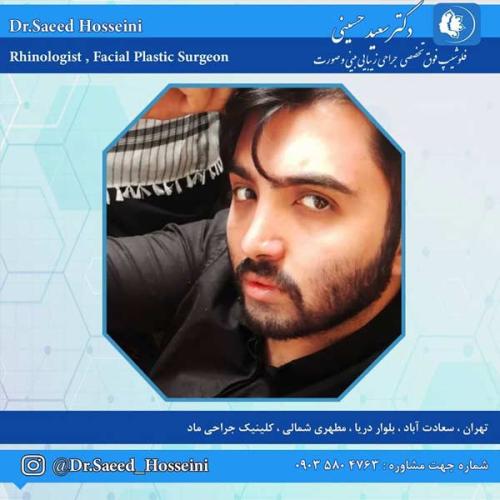 جراحی-بینی-264