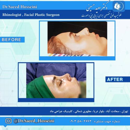 جراحی-بینی-265