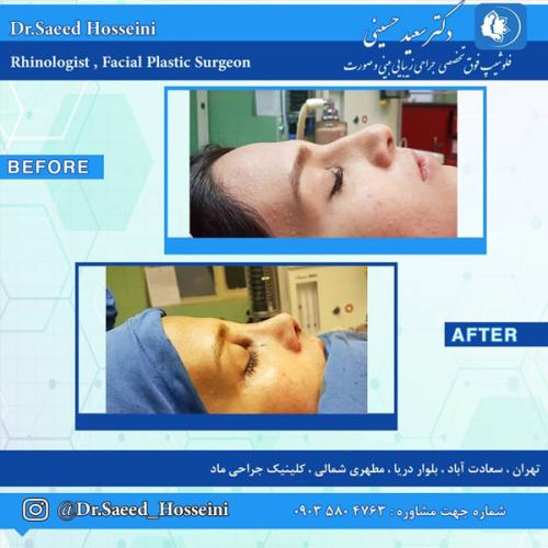 جراحی-بینی-266