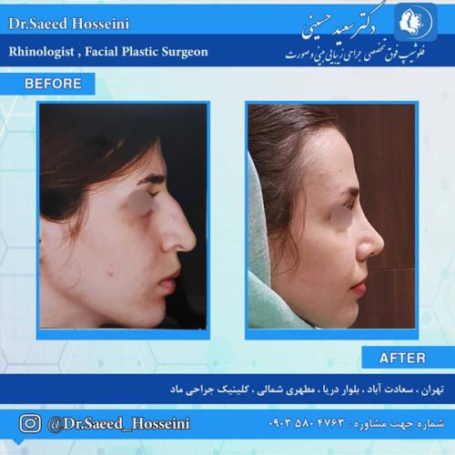 جراحی-بینی-267