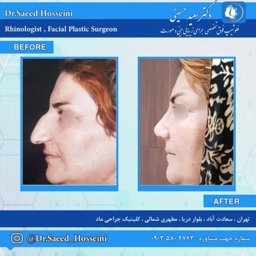 جراحی-بینی-268