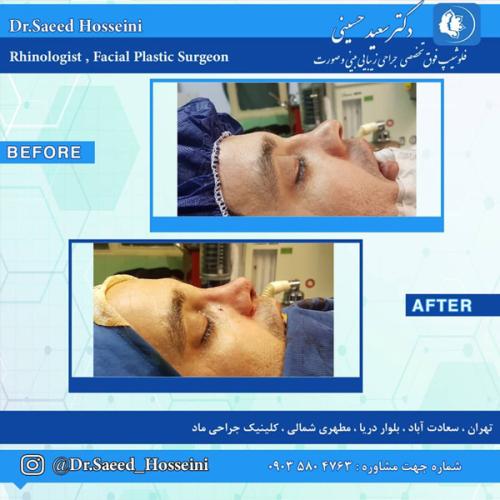 جراحی-بینی-270
