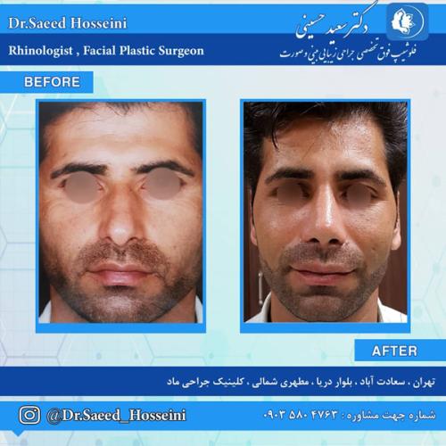 جراحی-بینی-271