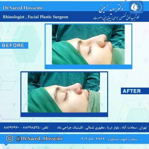 جراحی-بینی-282
