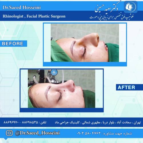 جراحی-بینی-283
