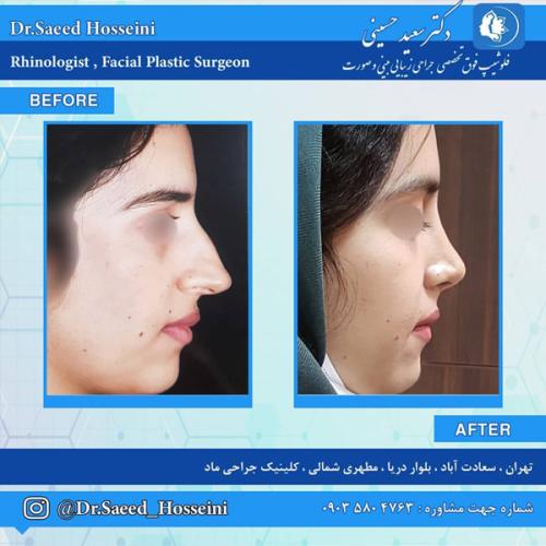 جراحی-بینی-285