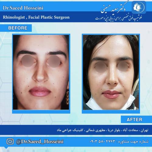 جراحی-بینی-286