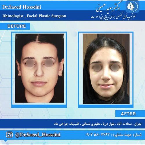 جراحی-بینی-289