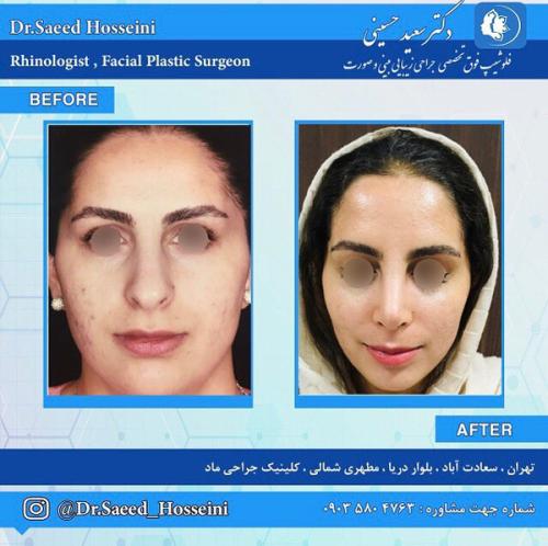 جراحی-بینی-292
