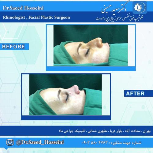 جراحی-بینی-293