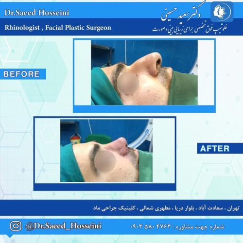 جراحی-بینی-294