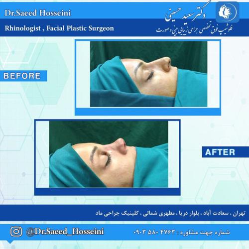 جراحی-بینی-295