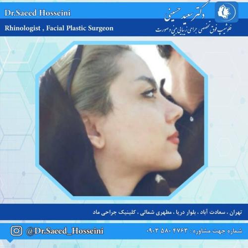 جراحی-بینی-329