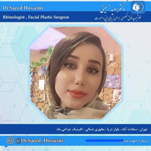 جراحی-بینی-331