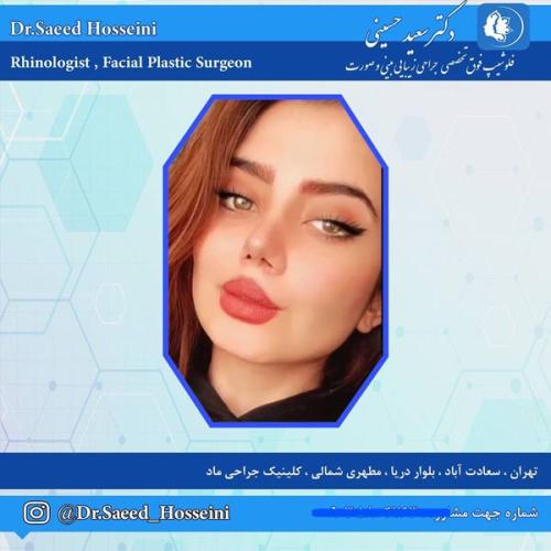 جراحی-بینی-332