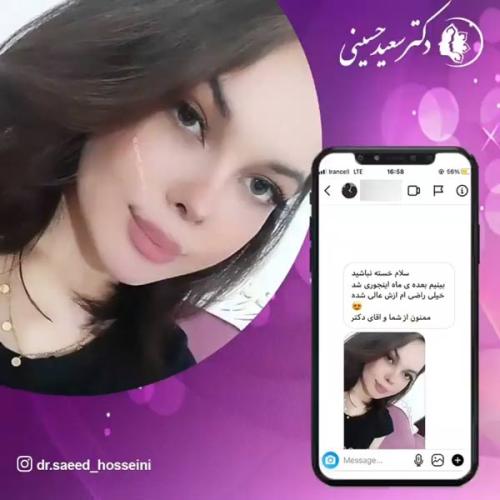 جراحی-بینی-334