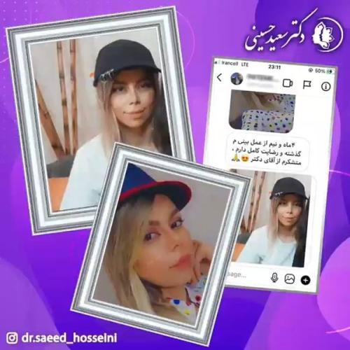 جراحی-بینی-337