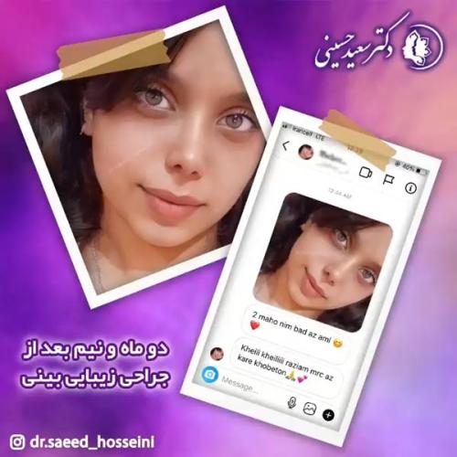 جراحی-بینی-338