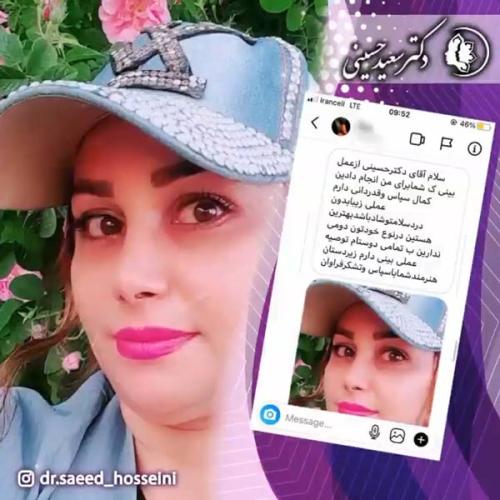 جراحی-بینی-340