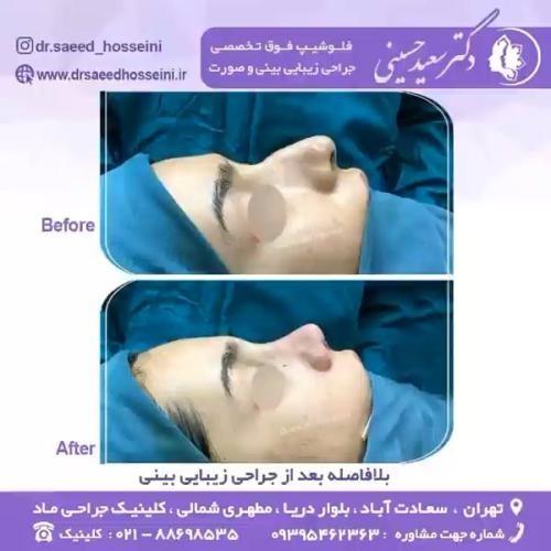 جراحی-بینی-341