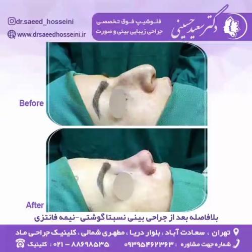 جراحی-بینی-342