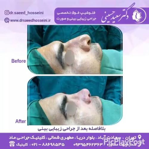 جراحی-بینی-343