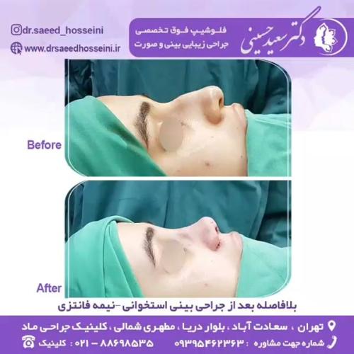 جراحی-بینی-344