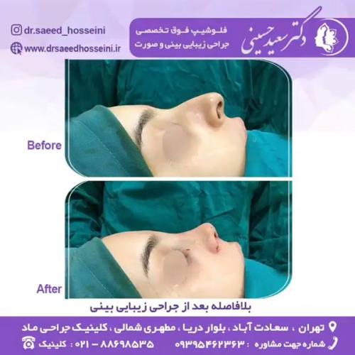 جراحی-بینی-345