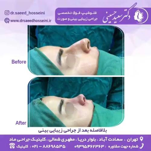 جراحی-بینی-346