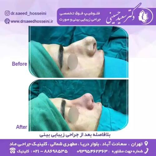 جراحی-بینی-347